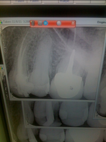 Tooth #12